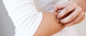 Раздражение рук - один из симптомов рожи